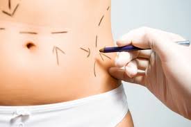 Lipoaspiración o aparatología: ¿qué conviene?